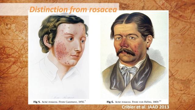 The history of lupus throughout the ages смотреть онлайн