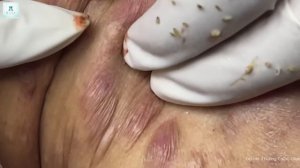 Big Cystic Acne Blackheads Extraction Blackheads & Milia, Whiteheads Removal Pimple Popping
