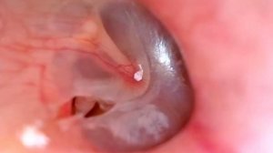 краевой дефект барабанной перепонки чем опасен?