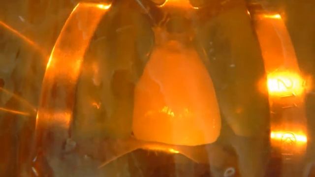 Композитная реставрация зубов при флюорозе (желтые зубы) + исправление скученности. смотреть онлайн