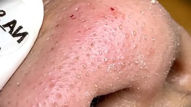 Relax squeezing out blackheads #29 Черные точки смотреть онлайн