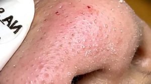 Relax squeezing out blackheads #29 Черные точки