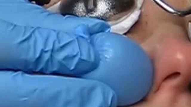 Косметологічна клініка "Брасс. Здорова шкіра" процедура лазерного видалення судинних утворень смотреть онлайн