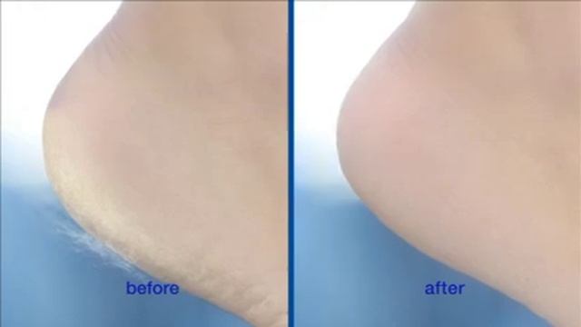 Scholl Velvet Smooth TV ad смотреть онлайн