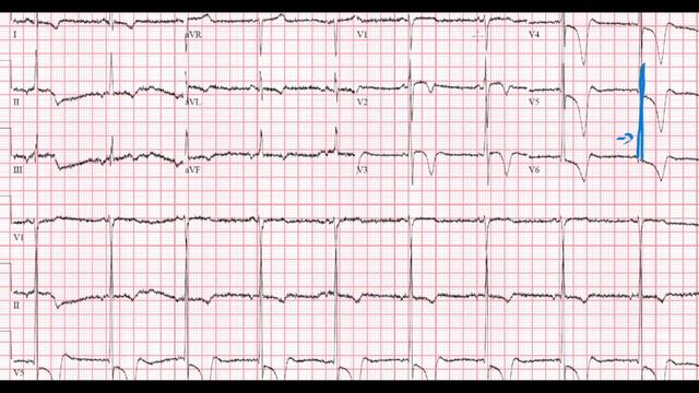 20 ECG - Quiz - Dr Synapse смотреть онлайн
