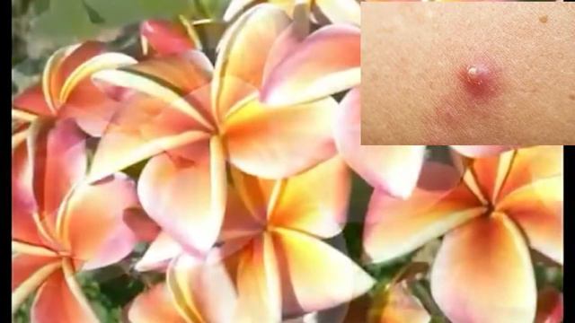 MANFAAT BUNGA KAMBOJA BAGI KESEHATAN смотреть онлайн