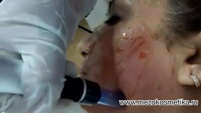 Дермапен Dr.Pen смотреть онлайн