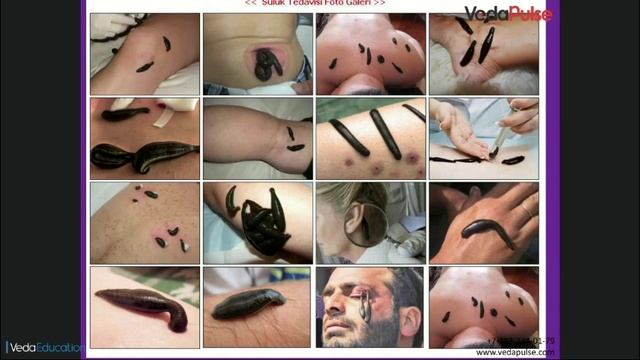 Лечение пиявками: за и против. Опыт применения гирудотерапии от практикующего врача смотреть онлайн