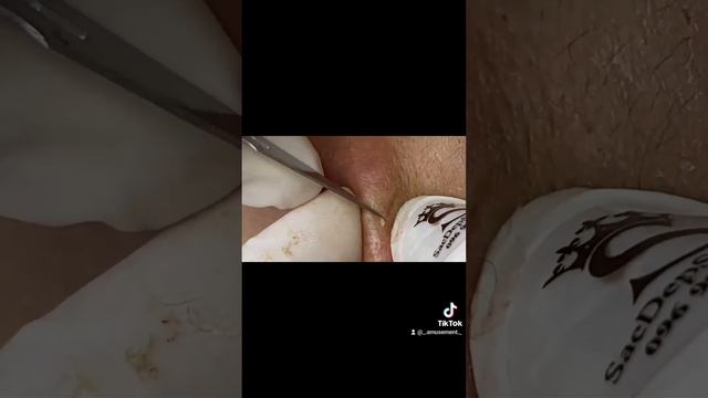 #асмр #прыщи #acnetreatment #asmracne #acne #acnetreatment #угри