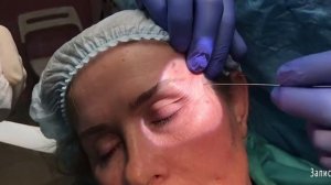 Нитевой лифтинг, блефаропластика