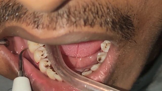 How to scaling teeth-দাঁত স্কেলিং কিভাবে করে-স্বাস্থ্য সেবা смотреть онлайн