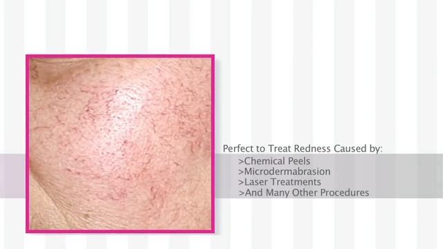 Calm Redness with Antirougeurs Calm Soothing Repair Mask смотреть онлайн