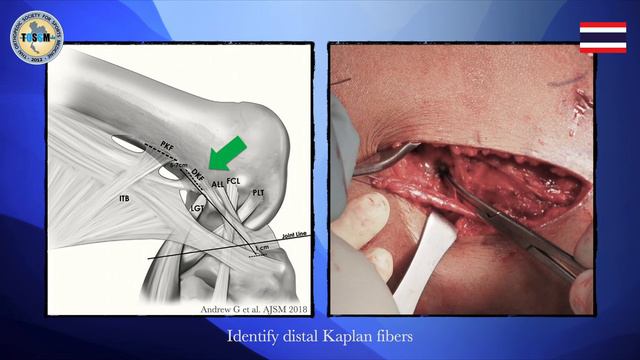 Lateral Extra-articular Tenodesis: Modified Lemaire Technique