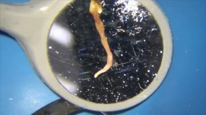 Удаление нерва в зубе под микроскопом