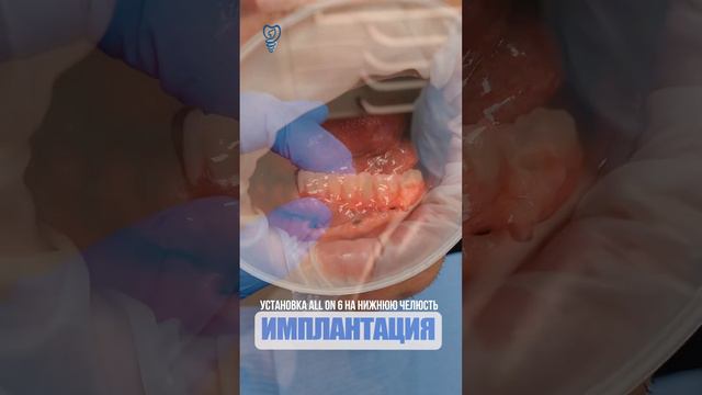 Установка all on 6 на нижнюю челюсть смотреть онлайн