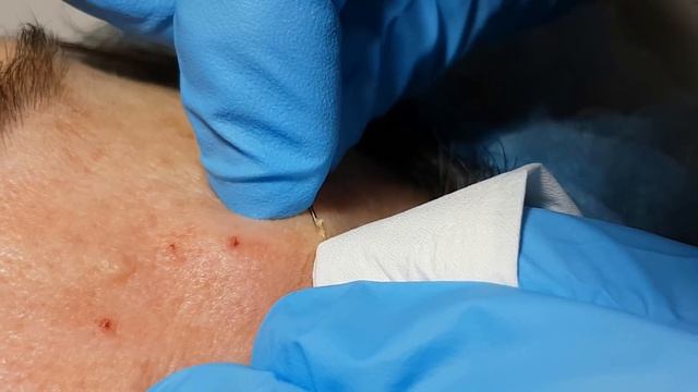 Removing Milia: Yellow Pearl Harvest - Part I смотреть онлайн