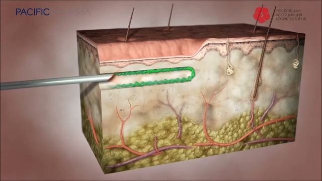 INNOFILL ИННОФИЛЛ