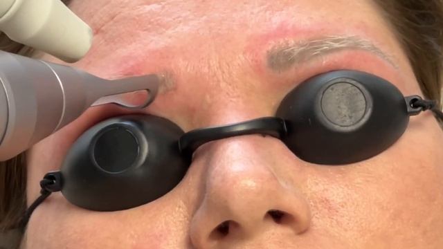Видалення татуажу брів лазером надкороткого імпульсу Pico-Light Brilliant ? смотреть онлайн