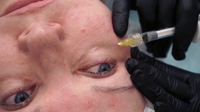 Итальянские филлеры Overage - подробный обзор и практика применения в косметологии смотреть онлайн