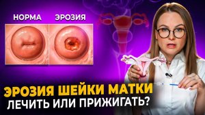 Эрозия шейки матки - лечить или не лечить, симптомы, причины эрозии шейки матки. Рак шейки матки.