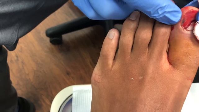 SQUIRTING TOE! ENTIRE NAIL REMOVED WITH SURPRISE UNDERNEATH! смотреть онлайн