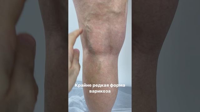 Редкая форма варикоза. Флеболог Москва. Флеболог. Узи вен. Как лечить варикоз? Лечение варикоза смотреть онлайн