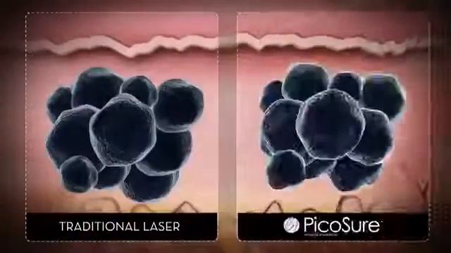 Лазеры PicoSure смотреть онлайн