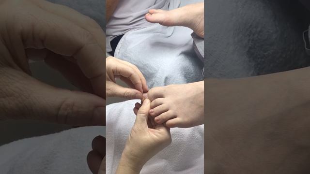 Коррекция ногтя титановой нитью - Подолог