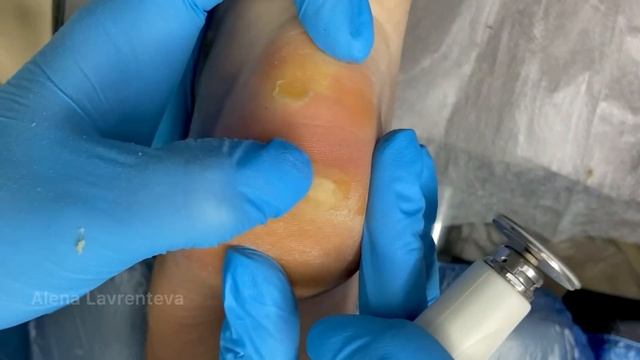 Если обувь велика / Натоптыш на пятке что делать / Купил большую обувь / Натоптыш на ноге / Мозоль смотреть онлайн