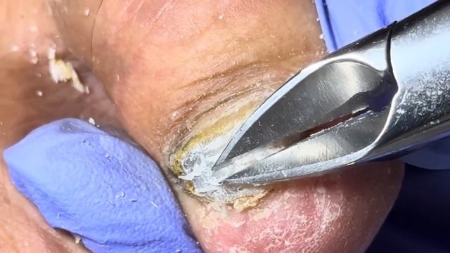 Wow~ Super thick onychomycosis, so hard that it falls off as soon as you cut it【Doctor Liu Pedicure смотреть онлайн