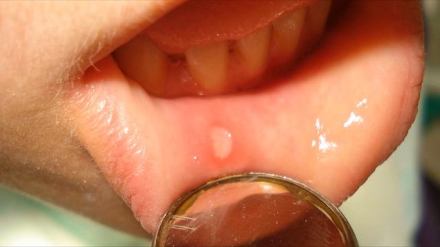 Рак губы первые симптомы смотреть онлайн