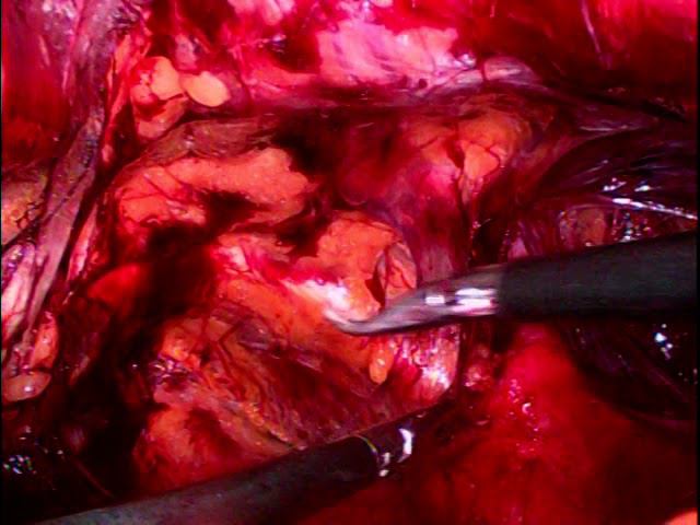 Laparoscopic ETEP Right Inguinal Hernia