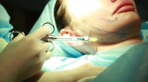 Тредлифтинг лица нитями Spring Thread