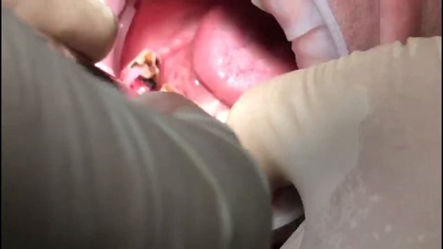 Удаление зубов щипцами / (Выпуск 3) смотреть онлайн