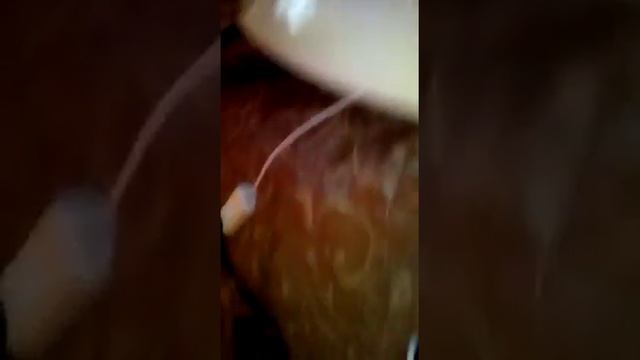 Хиджама ,кровопускание Часть1. смотреть онлайн