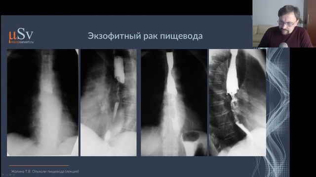 Рентгенодиагностика заболеваний органов пищеварения (Часть Вторая)