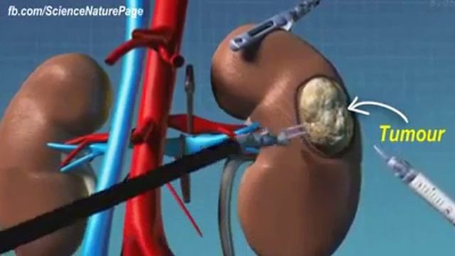 Операция на Роботе Да Винчи виртуозная техника и тончайшая работа смотреть онлайн