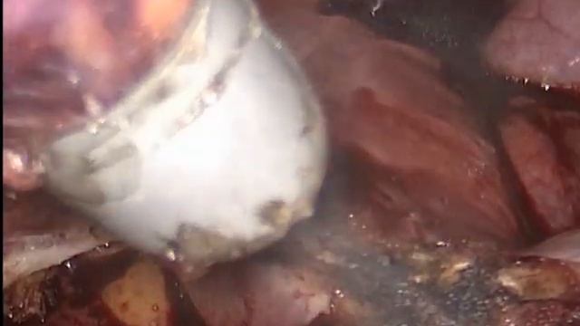 Миома матки больших размеров. Лапароскопическая миомэктомия. смотреть онлайн