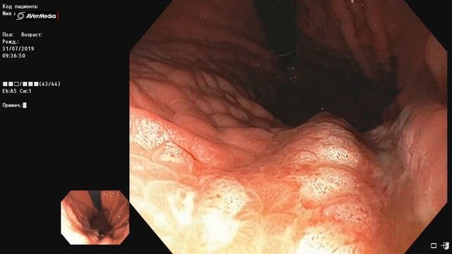 Типичная мацерация СОЖ препаратами висмута смотреть онлайн