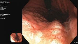 Типичная мацерация СОЖ препаратами висмута