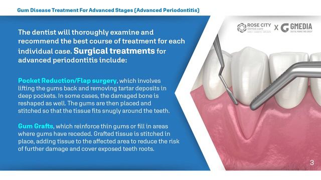 [Rose City Dental Care] Storytelling: Gum Disease Treatment For Advanced Stages смотреть онлайн