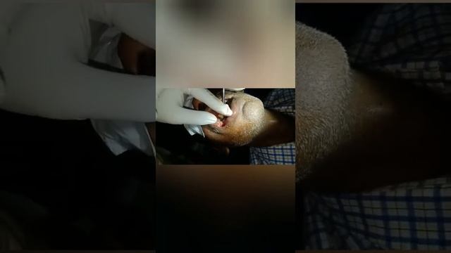 Maggots in mouth, poor oral hygiene, tobacco chewing, a case of Odisha смотреть онлайн