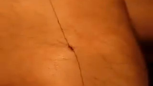 Вынимаем клеща из тела с помощью нитки смотреть онлайн