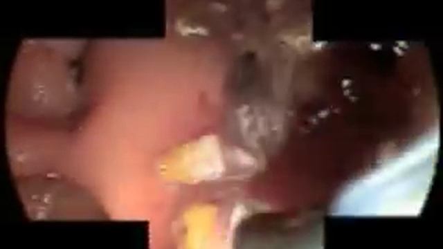 Cannulation of the Common Bile Duct Revealing Numerous Leaf-shaped Worms смотреть онлайн