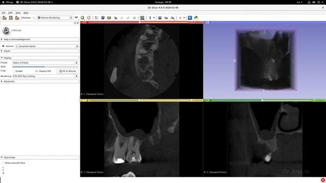 3D Slicer запуск в Linux (просмотр КТ в стоматологии) смотреть онлайн