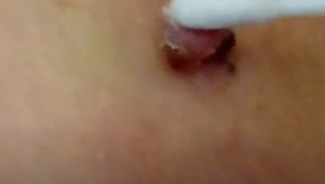 Удаление папилломы чистотелом дома 1.