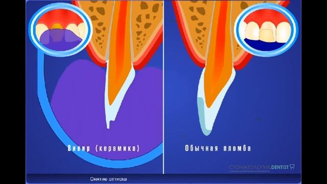 Винир или пломба на зуб? Что лучше ? смотреть онлайн