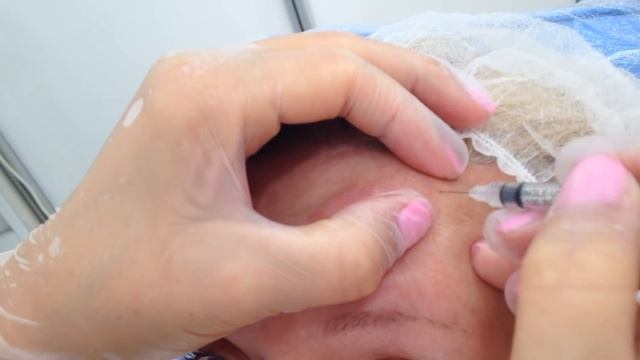 Обучение ботокс лоб и межбровье смотреть онлайн