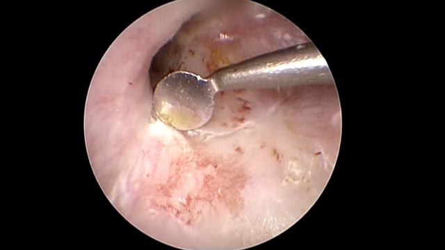 Radiofrequency Application in Endoscopic Ear Surgery Using ARROWtip™ | Sven Geukens, MD смотреть онлайн