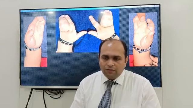 #pinnacleorthocentre Birth Defects in Hand, Understanding a case of Syndactyly | Dr.Parag Lad смотреть онлайн